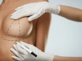 Как выбрать специалиста по маммопластике: ключевые критерии